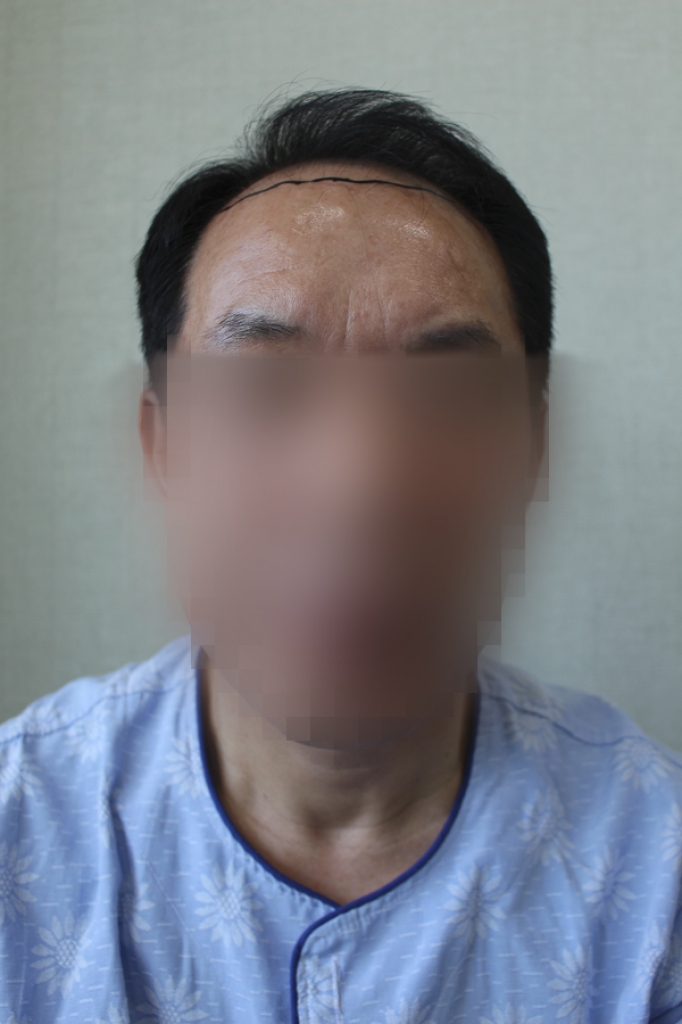 모발이식전2.jpg