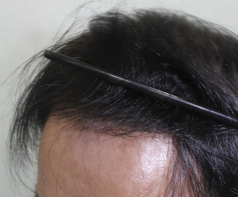 수술후_3.jpg