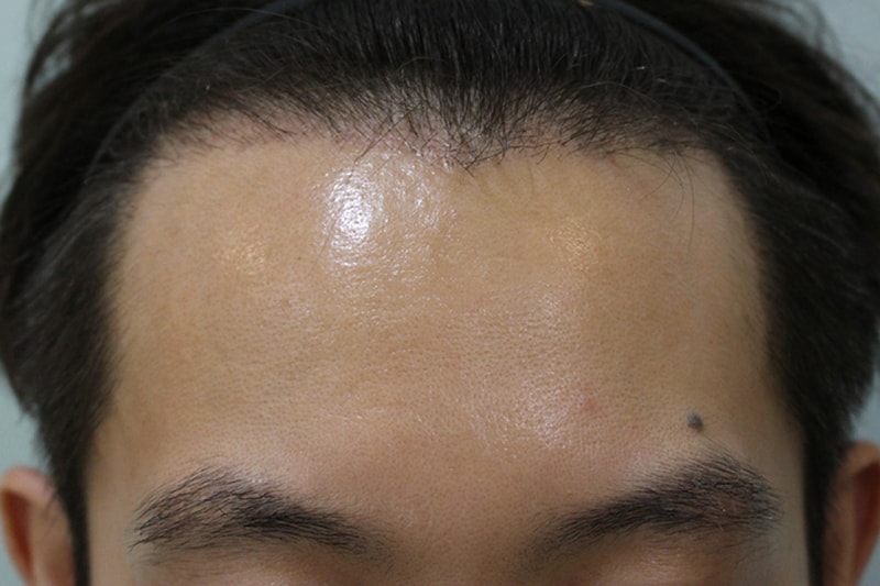 수술후2개월 (1).JPG