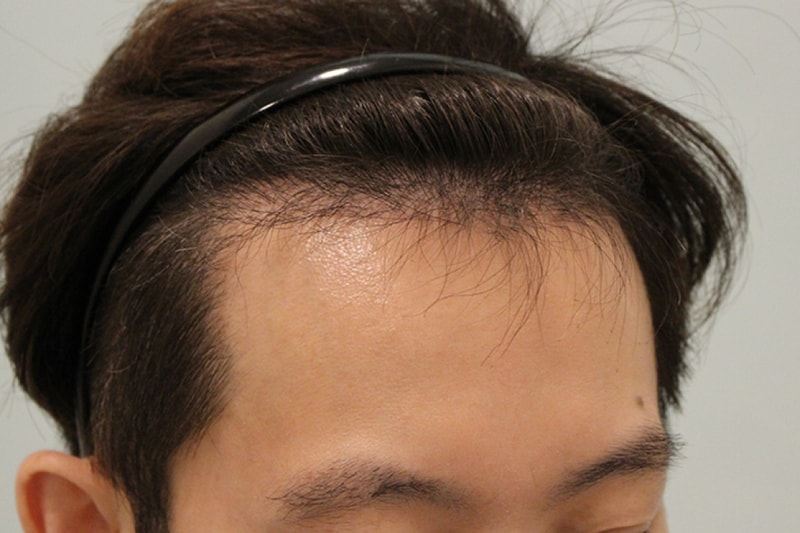 수술후4개월 (7).JPG