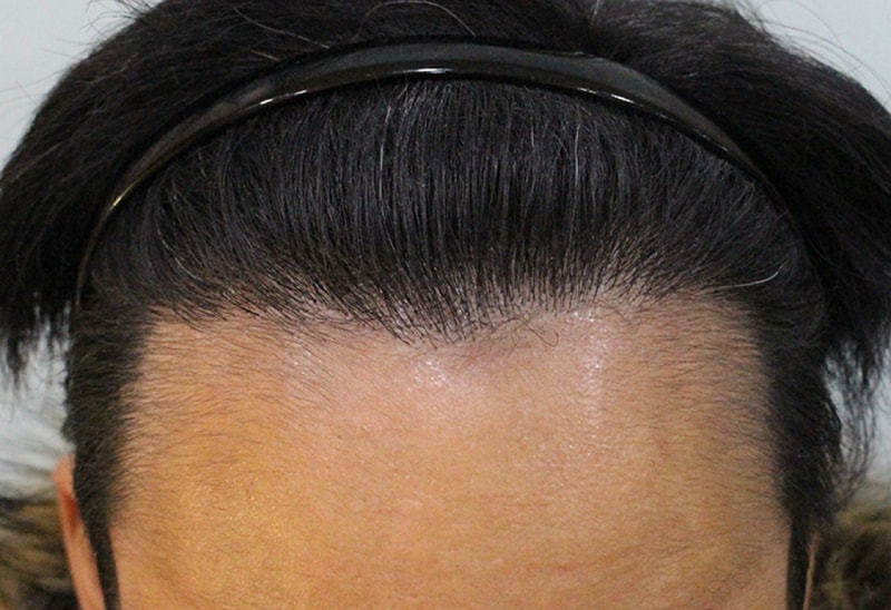 수술후1년 (3).JPG