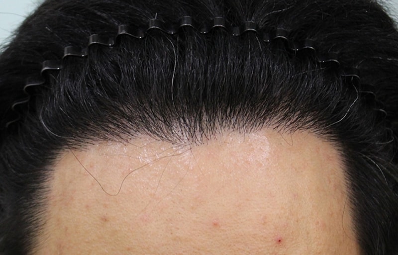 수술후 9개월 (3).JPG