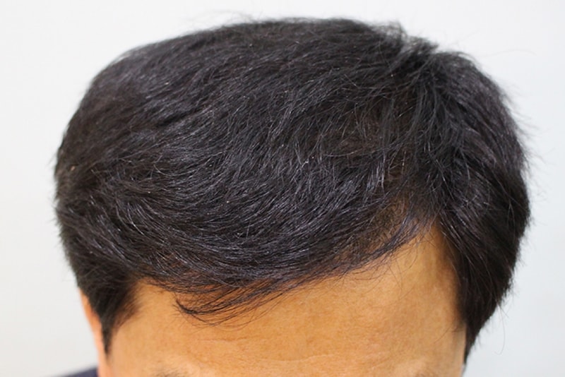 수술후10일 (2).JPG