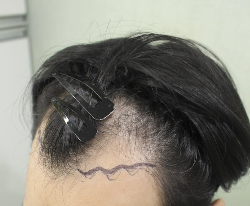 이식전 (4).png