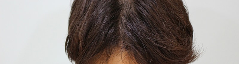 수술후 5개월 (8).JPG
