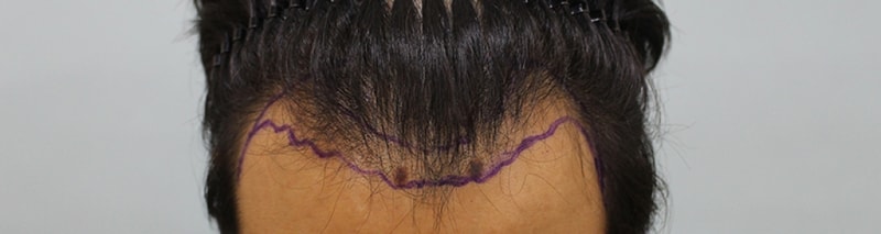 수술전디자인 (3).JPG