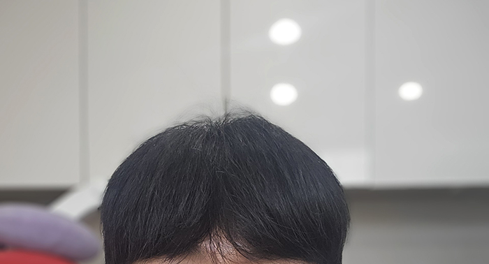 5. 이식하고 처음으로 이발도 했어요.jpg