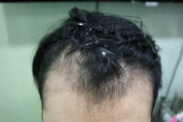 비절개 3074모 이식 3개월 반 됐습니다