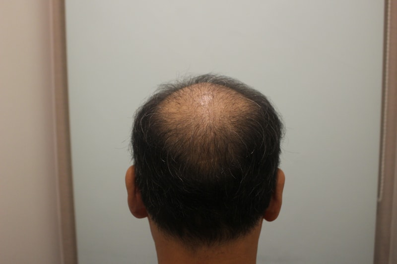 수술후 4개월 5.JPG