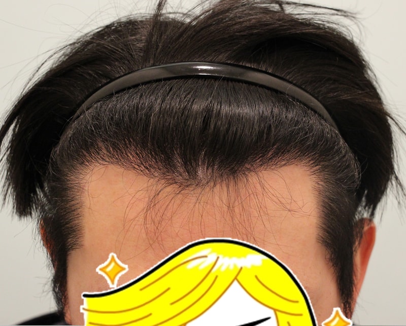 수술후 7개월.jpg