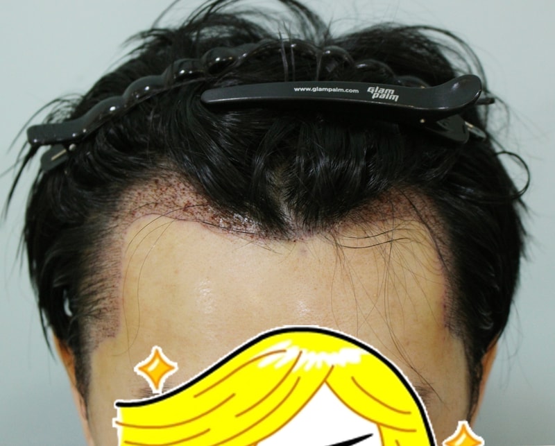 수술후.jpg