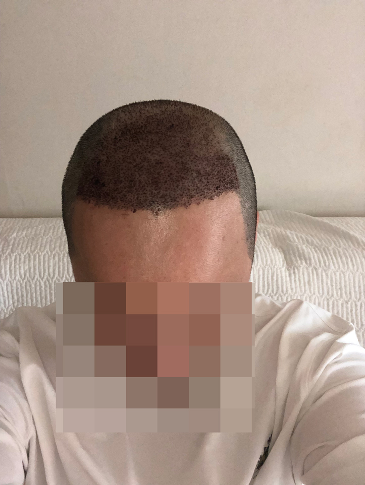 Dana Plastic Surgery Department Bulk Hair Transplantation 7000 Mothers 2 Months