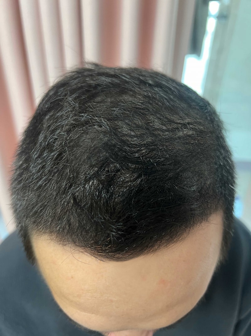 Dana Plastic Surgery Mass non-cut hair transplant 7000 mother more than 5 months old