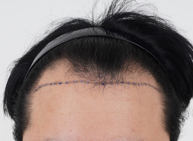 [Momo's Daegu branch surgery review] I got 3,800 moles transplanted.