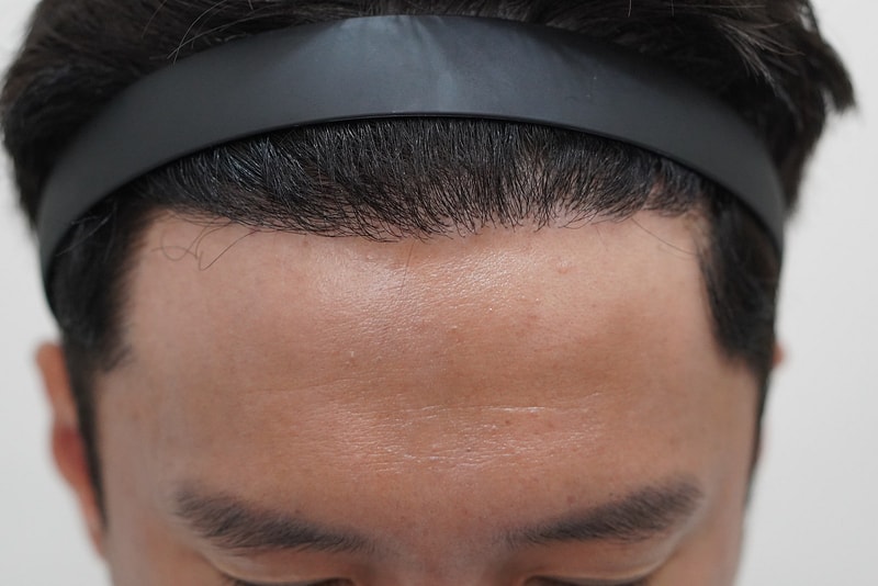 그로우의원(구 뉴헤어부산) 모발이식 1년 경과 후기