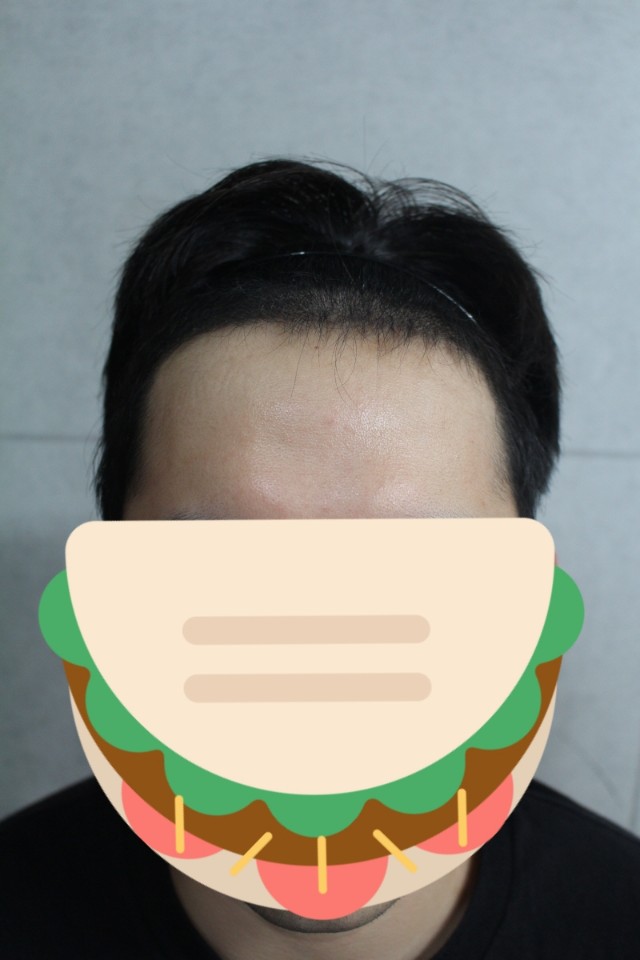 M자 2200모 모발이식 4개월차