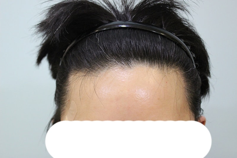 수술후일년 (1).JPG