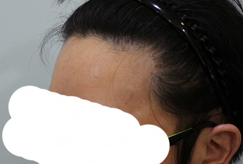 수술후일년 (3).JPG