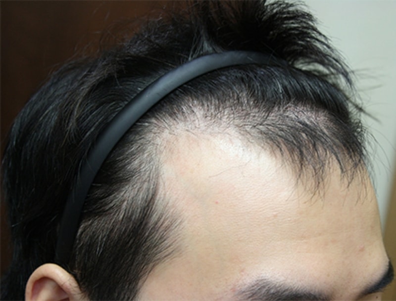 수술전측면.jpg