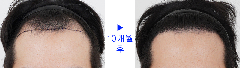모발이식 후 10개월인데 다 완성됐네요