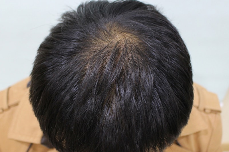수술후 10일 (20).JPG