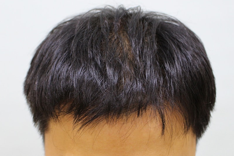 수술후 10일 (14).JPG