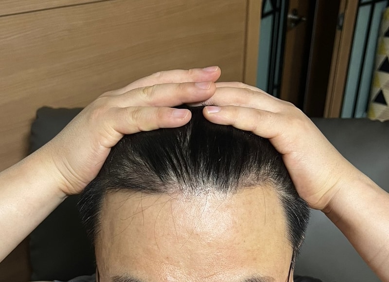 다나 재수술 중간 경과