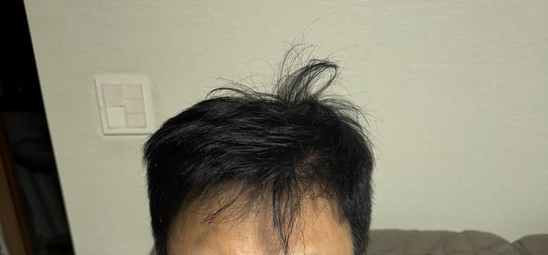 다나 재수술 무삭발 이식 7개월 경과 후기입니다.