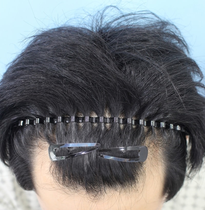 이식 받은지 이제 8개월 되었어요