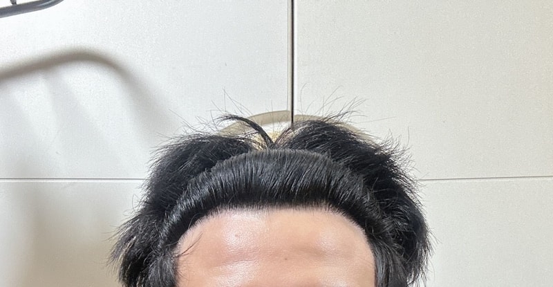 다나 M자 무삭발 모발이식 21개월!