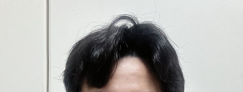 다나 M자 무삭발 비절개 18개월 경과 사진