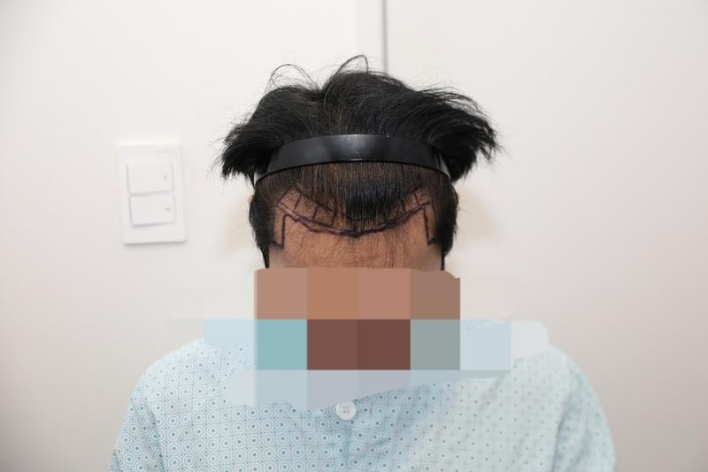 뉴헤어 모발이식 1800모낭 7개월차 후기