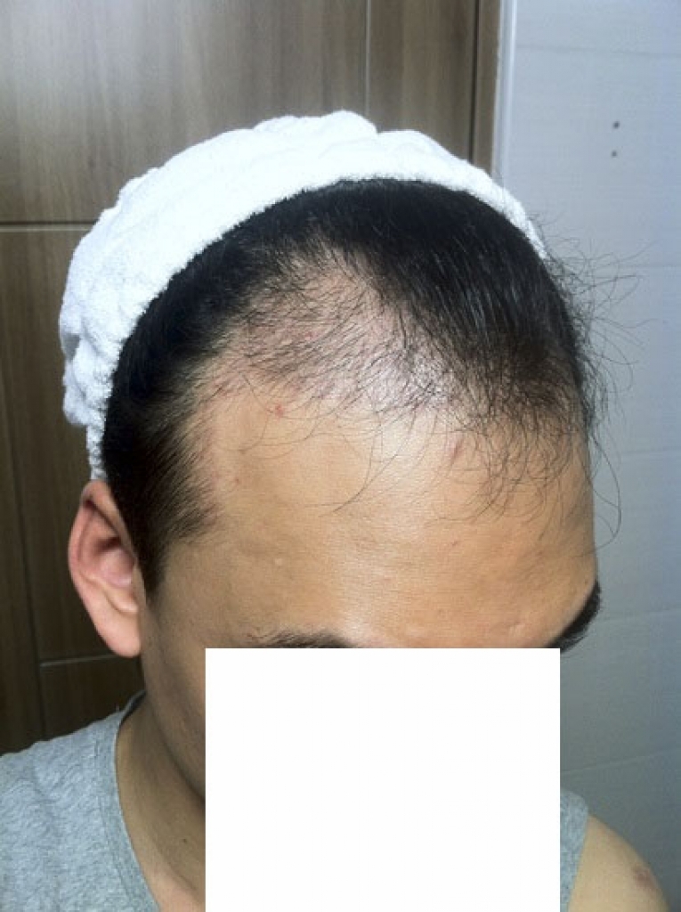 다나 절개4천모 석달되었습니다