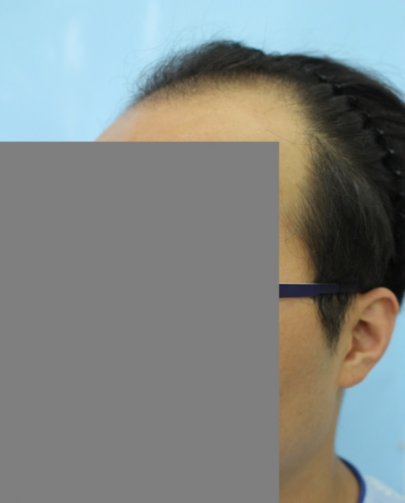 이식 밀도 봐주시면 감사하겠습니다