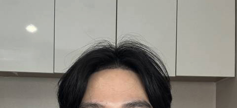 4-머리심은게 좋아서 티나더라도 그냥 이마 까고 다니고 있어요 내리면 생착에 안좋을 것 같은 걱정이 ㅠ.jpg