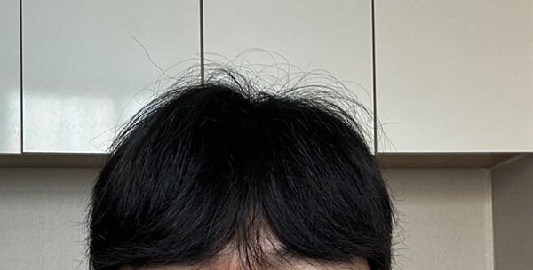 5. 2주차까진 짧지만 채워져보여서 이마 까고 다녔는데 많이 털려서 머리내리고 다닙니다 오늘 주사 맞아서 주말에 머리 자르려구요.jpg