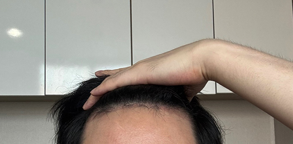 1. 암흑기 정면 사진입니다 안 빠진머리들은 자라고 있는데 꽤 많이 빠졌어요...jpg