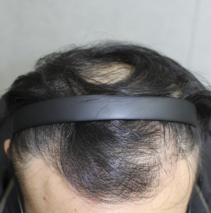 IMG_4538_8개월경과.png