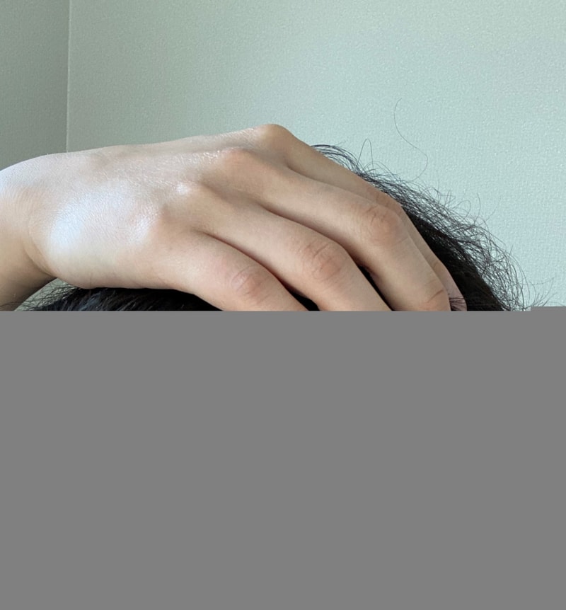 5개월 1800모낭 비절개 다나성형외과