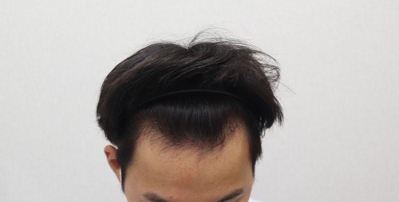 수술전.jpg