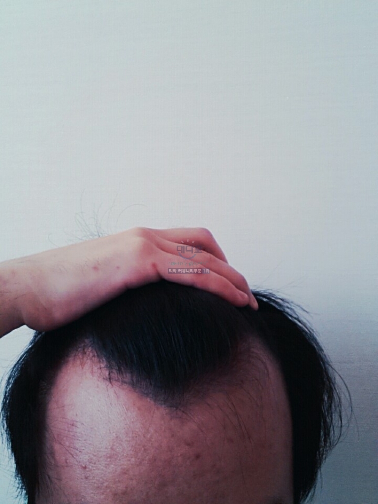 다나 절개 3200모 5개월차... 암흑기를 벗어나는 중....