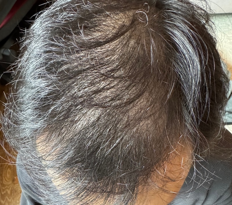 Four months after non-excisional hair transplantation