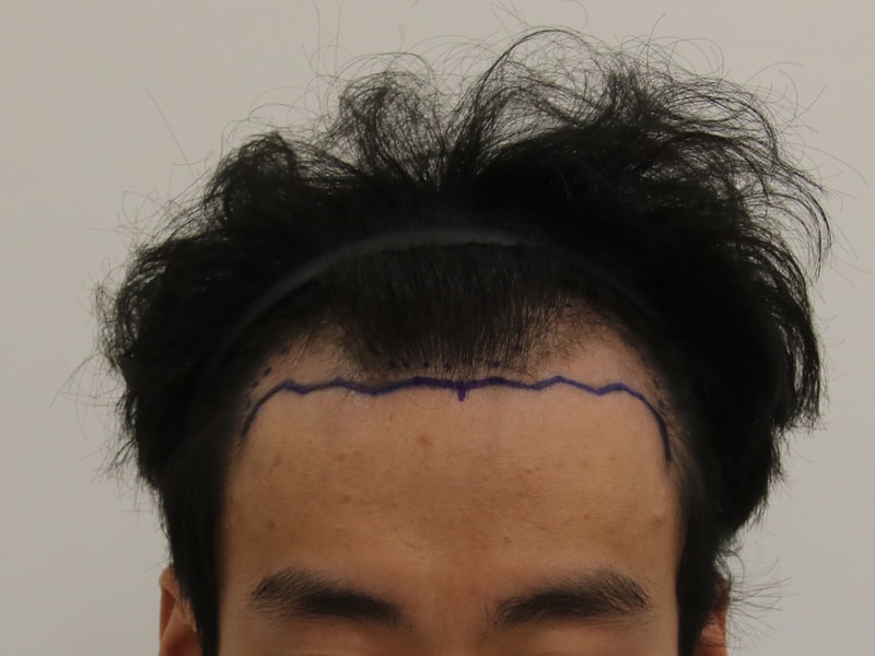 부산 맘모스 M자 모발이식 7개월 경과 후기