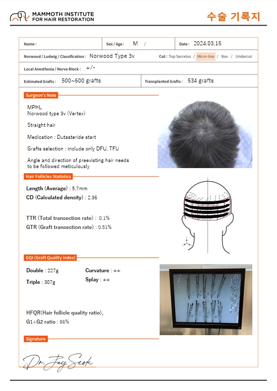 압구정맘모스헤어라인 정수리 모발이식 수술후기