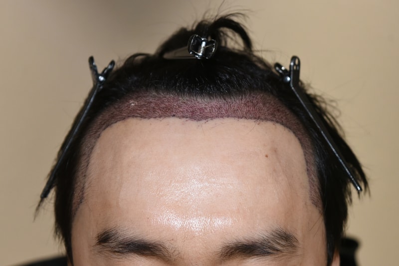1일차 샴푸후.jpg