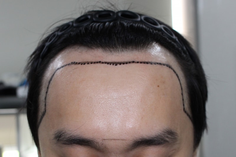 이식전.jpg