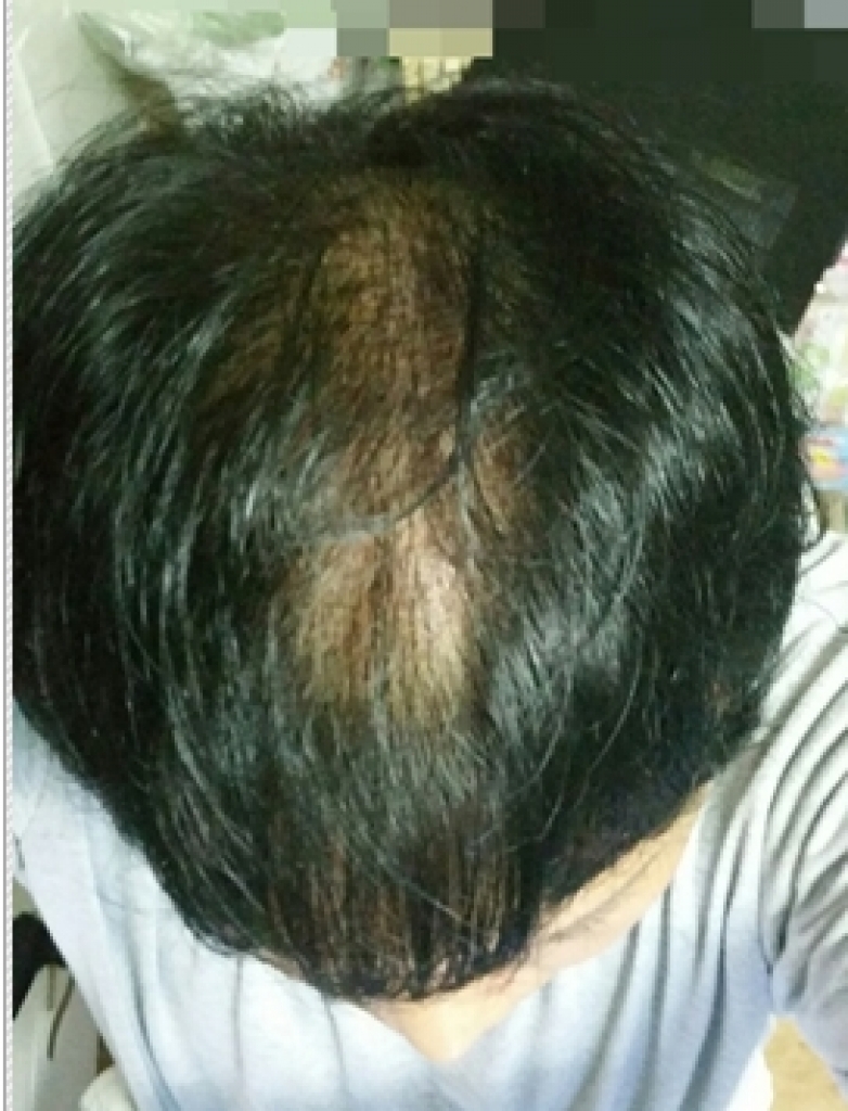 각질제거 후 머리.png