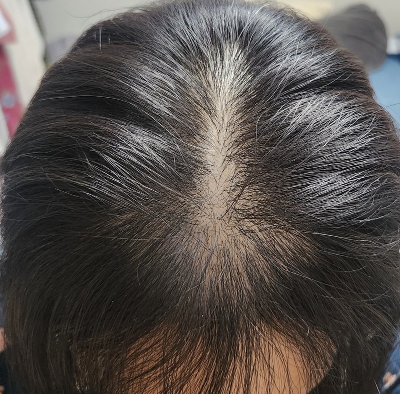 [So detailed!]Female top part hair loss, no-cut non-cut surgery review!!