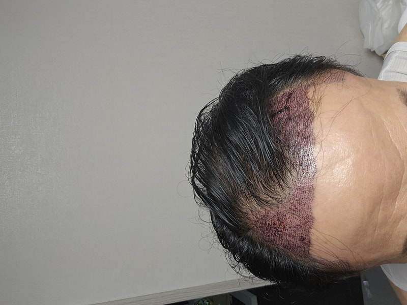 모발이식 한달차 예외없는 암흑기