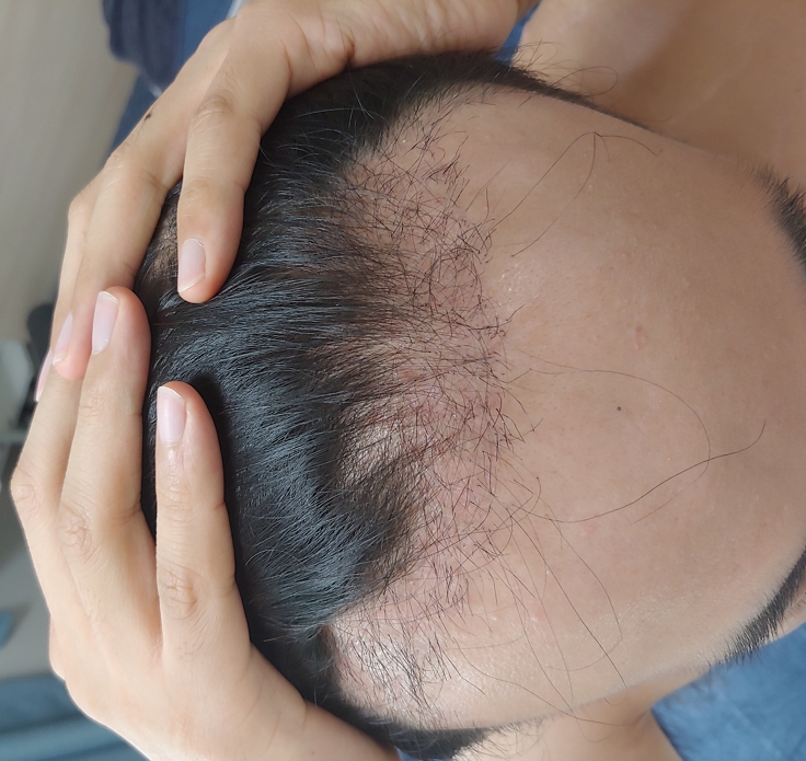 수술한지 1달!! 37일이 지났습니다.